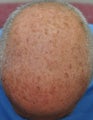 Male Patient Treated for Significant Sun Damage on Scalp