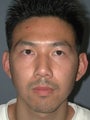 Otoplasty/Ear Surgery