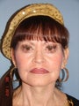 65 year old female desiring facial rejuvenation 