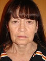 65 year old female desiring facial rejuvenation 