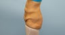 Tummy Tuck