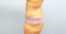 Tummy Tuck