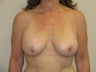 52 year old female with 400 cc saline breast implants