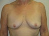 52 year old female with 400 cc saline breast implants