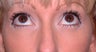 Lower Eyelid Surgery, Lower Blepharoplasty