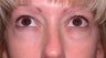 Lower Eyelid Surgery, Lower Blepharoplasty