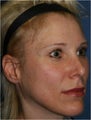 47 year old female treated for droopy eye brows and eye lids