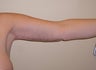 34 year old woman has Brachioplasty