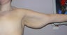 34 year old woman has Brachioplasty