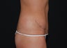 Abdominoplasty
