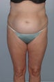 Female patient who underwent a tummy tuck 