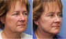 50 year old female one month after mini facelift
