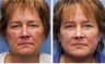 50 year old female one month after mini facelift