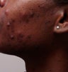 Accutane