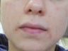 Acne Scars Treatment