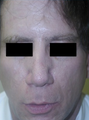 Acne Scars Treatment