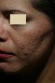 Acne Scars Treatment