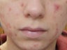 Acne Scars Treatment