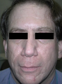 Acne Scars Treatment