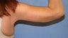 Arm lift