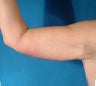 Arm lift