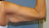 Arm lift
