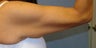 Arm lift