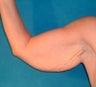 Arm lift