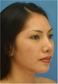 Asian Rhinoplasty