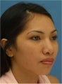 Asian Rhinoplasty