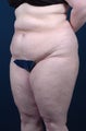 Body lift