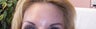 Botox