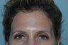 Botox