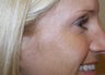 Botox