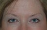 Botox
