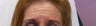 Botox
