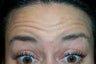 Botox