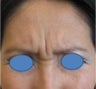 Botox