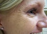 Botox