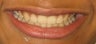 Braces