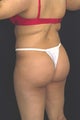 Brazilian butt lift