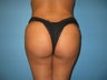 Brazilian butt lift
