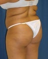 Brazilian butt lift