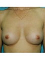 Breast Augmentation