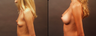 Breast Augmentation