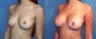 Breast Augmentation