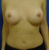 Breast Augmentation
