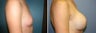 Breast Augmentation