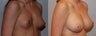Breast Augmentation
