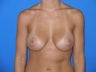 Breast Augmentation